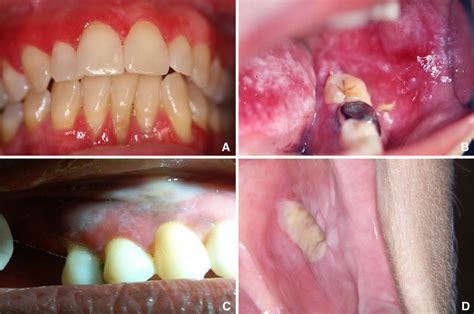 Clinical Examples Of Cus A Diffuse Gingival Erythema B Zones Of