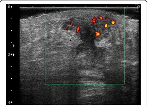 Ultrasonography Revealed A Hypoechoic Lesion 20 Mm In Size With Border