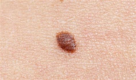 Is Your Mole Dangerous 9 Things To Check To Avoid Skin Cancer