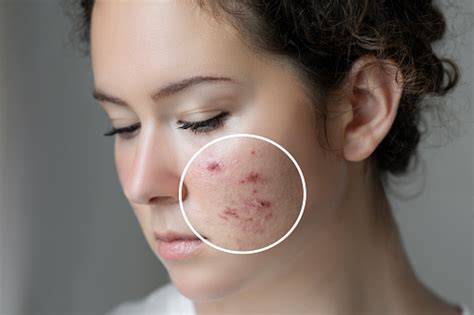 Acne Cause And Solutions For Mens And Womens Neody Health And Fitness