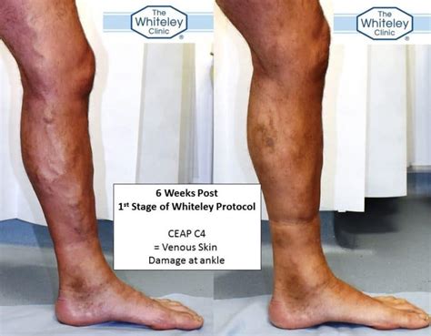 Varicose Veins And Venous Eczema Ceap C4 Whiteley Protocol