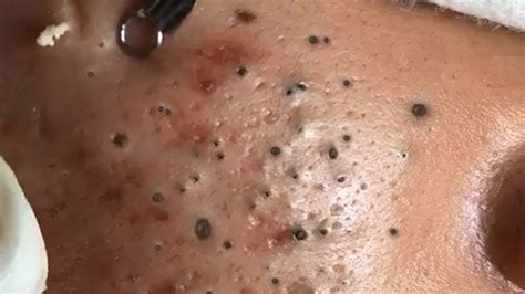 Big Cystic Acne Blackheads Extraction Blackheads Removal Pimple Popping Md Youtube