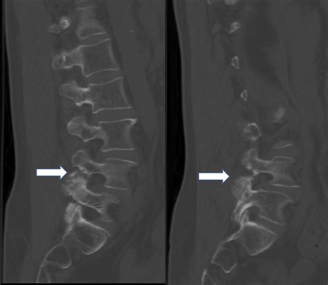 Osteoid Osteoma On The Way Of Pedicle Screw Insertion For Spinal Fusion