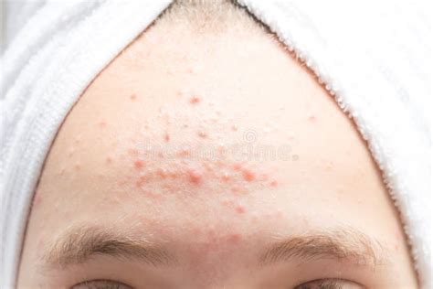 Pimple Blackheads On The Forehead Stock Photo Image Of Teenager