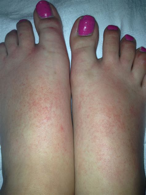 Himy 14 Yr Old Daughter Developed A Vasculitis Type Rash