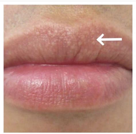 White Discoloration Spots On Lips