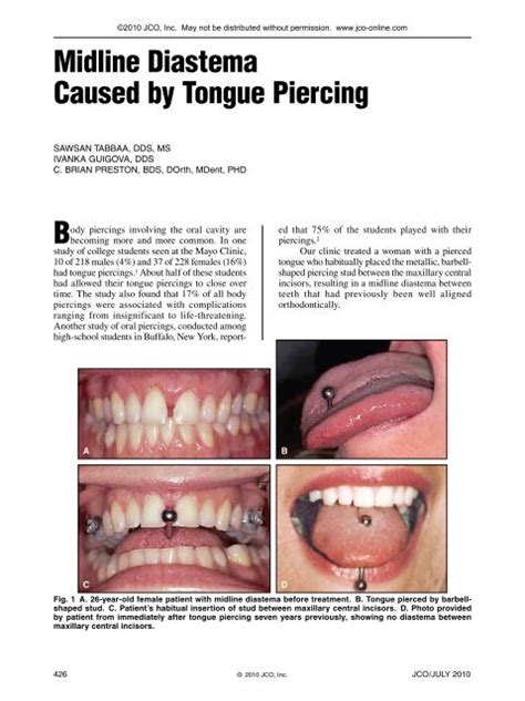 Midline Tongue Piercing