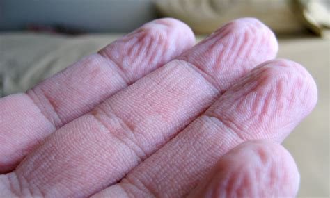 Why Do Your Fingers Or Hands Wrinkle In Water
