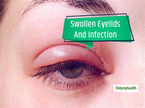 Swollen Eyelid — Causes Treatment And More