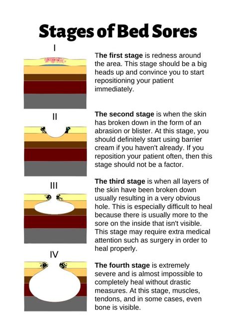 Stages Of Bed Sores Chart Poster For Sale By Caregiverology Bed