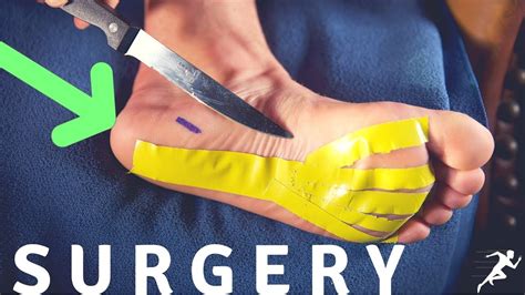 Plantar Fasciitis Surgery A Runners Story Youtube