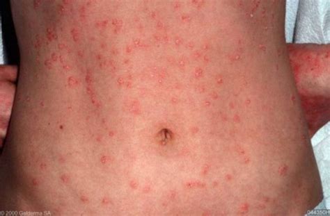 Guttate Psoriasis Symptoms Stages Causes Diagnosis And Treatment