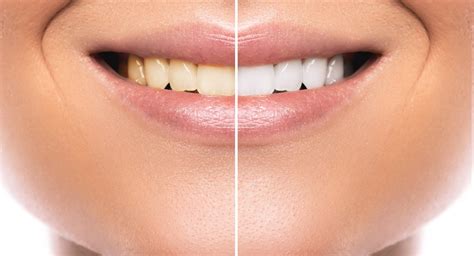 3 Reasons To Ditch Teeth Whitening Kits Pb Smile Studio
