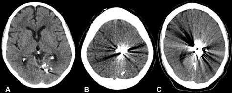 Un Enhanced Ct Scans Of The Brain After Embolization Of Arteriovenous