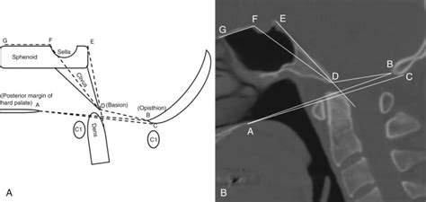 Imaging Of The Craniovertebral Junction Radiology Key