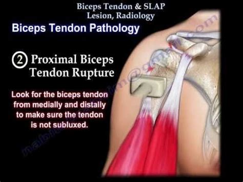 Biceps Tendon SLAP Lesion Radiology Everything You Need To Know