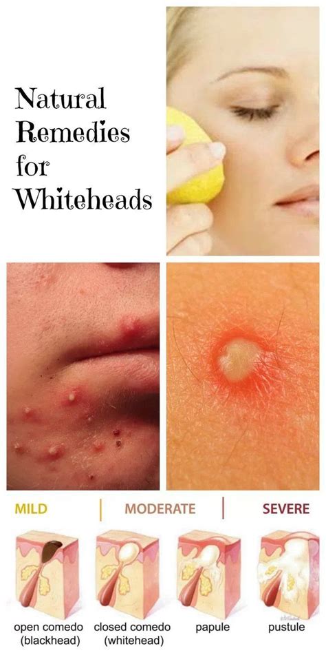 15 Home Remedies For Whiteheads Skin Care Beauty Skin Weird Beauty