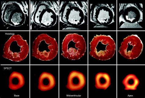 Cardiovascular Mri For Detection Of Myocardial Viability And Ischaemia