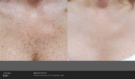 Photofacial Ipl Laser Luxe Dermatology — Luxe Dermatology And Aesthetics