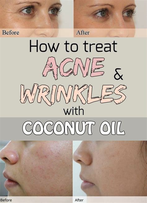 How To Treat Acne And Wrinkles With Coconut Oil