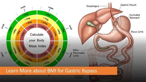 Pin On Gastric Bypass Surgery