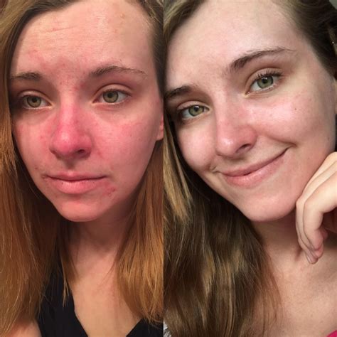 Banda What 6 Months Sca Advice Did To My Dry Flaky And Bright Red Face