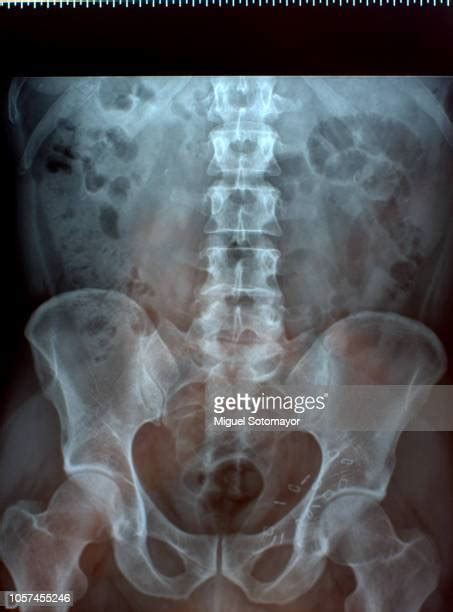Hernia Stomach Photos And Premium High Res Pictures Getty Images