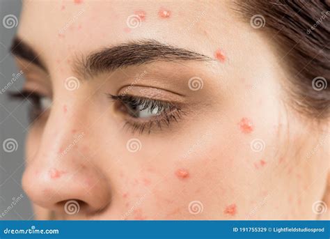 Close Up Of Woman With Pimples On Face Stock Image Image Of Girl
