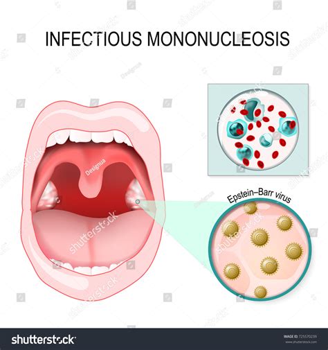 781 Mononucleosis Images Stock Photos And Vectors Shutterstock