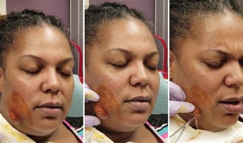 Skin Abscess Pictures