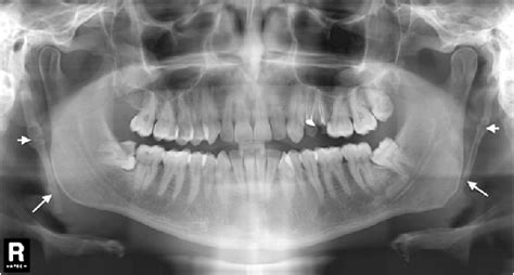 Calcification Of Stylohyoid Ligament