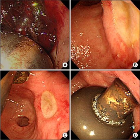 Endoscopic Imaging Of Peg Procedure Using The New Modified Introducer