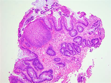 Pathology Outlines Barrett Esophagus