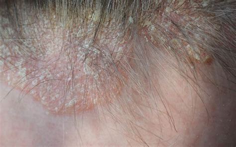 Scalp Infections 6 Types And Ayurvedic Ways To Treat Them Vedix