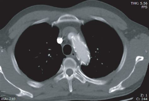 A Ct Angiography Scan Revealed Double Lumen Aortic Arch Structure