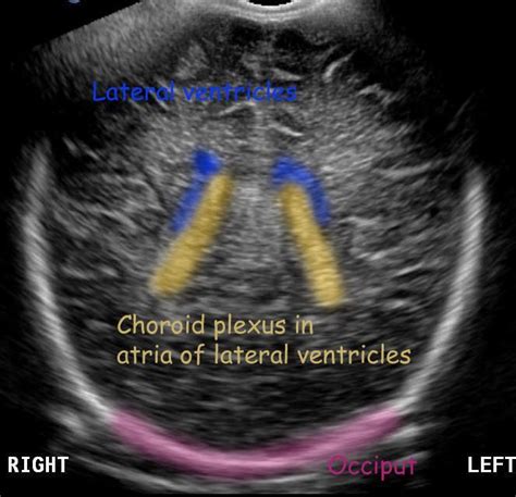 Normal Neonatal Brain Ultrasound Anatomy