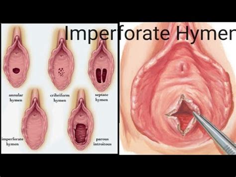 Imperforate Hymen Congenital Deformity Viral Medical Physiology Youtube