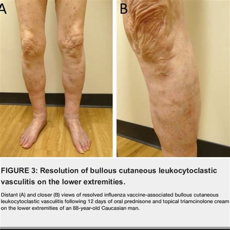 Bullous Cutaneous Leukocytoclastic Vasculitis On The Upper Extremities