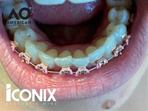 Iconix Braces At Refine Specialist Dental Care Gold Coloured Braces Orthodontics In Alfreton