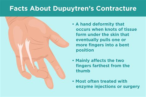 Dupuytrens Contracture Common Questions And Answers