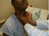 Images of Lymph Nodes On Both Sides Of Neck