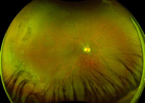 Retinal Holes And Tears Recognizing Pathology Optos