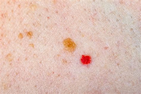 Preventive Medicine Rash That Looks Like Little Blood Spots