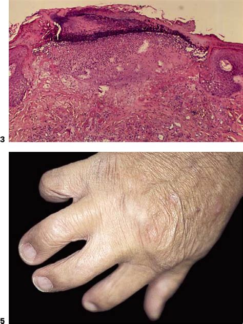 Figure 2 From Acquired Perforating Dermatosis In A Patient With Poland