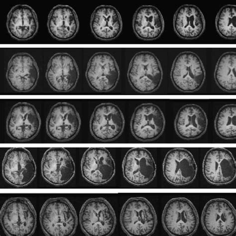 Axial Anatomical T1 Mri Scans From Selected Peri Sylvian Slices In Five