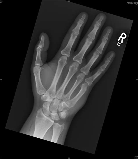 Hamate Body Fracture Hand Orthobullets
