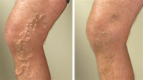 How Laser Technology Is Used To Treat Varicose Veins The Indian Wire