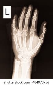 Xray Left Hand Show Closed Fracture Stock Photo Shutterstock