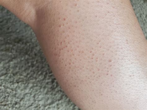 Need Help I Have These Tiny Bumps On My Leg How Do I Get Rid Of Them