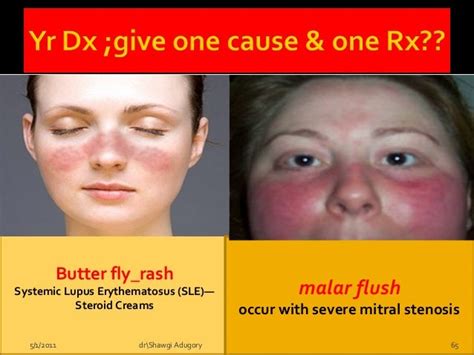 Lupus Butterfly Rash Vs Rosacea